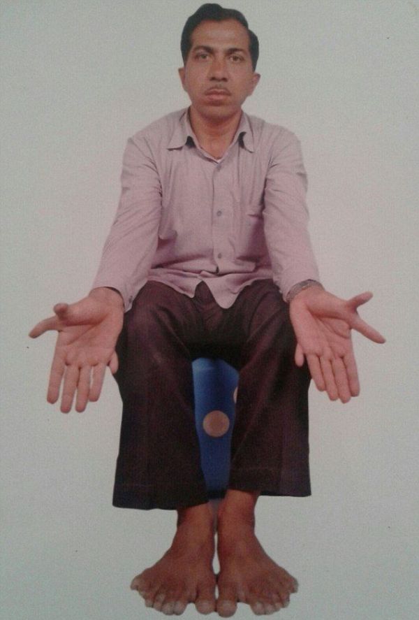 Девендра Сутхар - рекордсмен по количеству пальцев